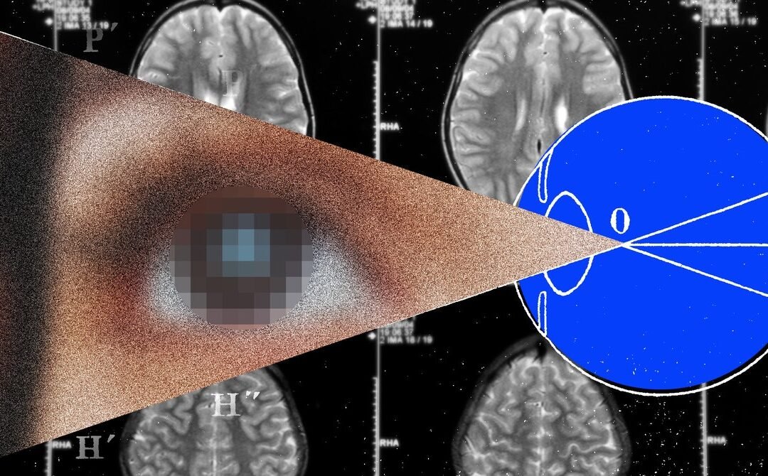 The Next Frontier for Brain Implants Is Artificial Vision